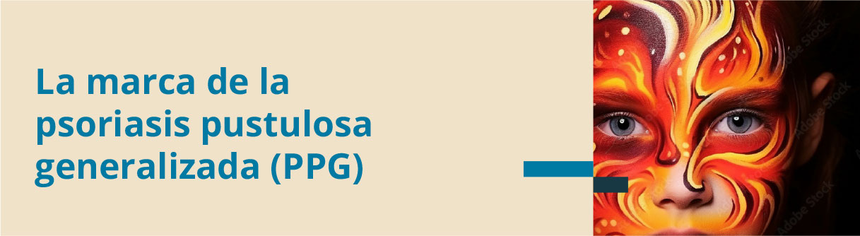 ¿Te has cruzado ya con la psoriasis pustulosa generalizada?