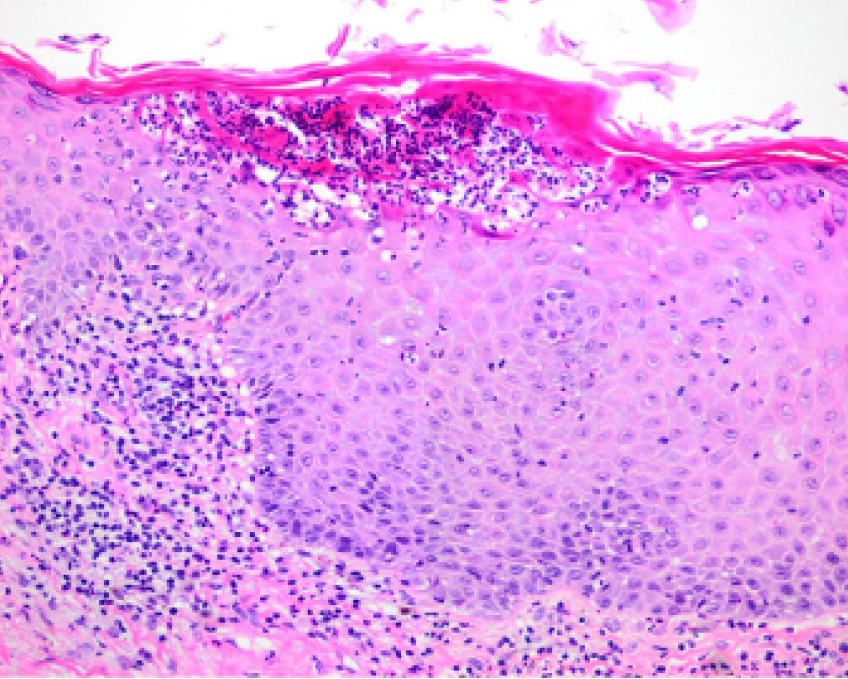 Muestra histológica de pústula subcórnea  espongiforme con cambios epidérmicos e  infiltración linfocítica