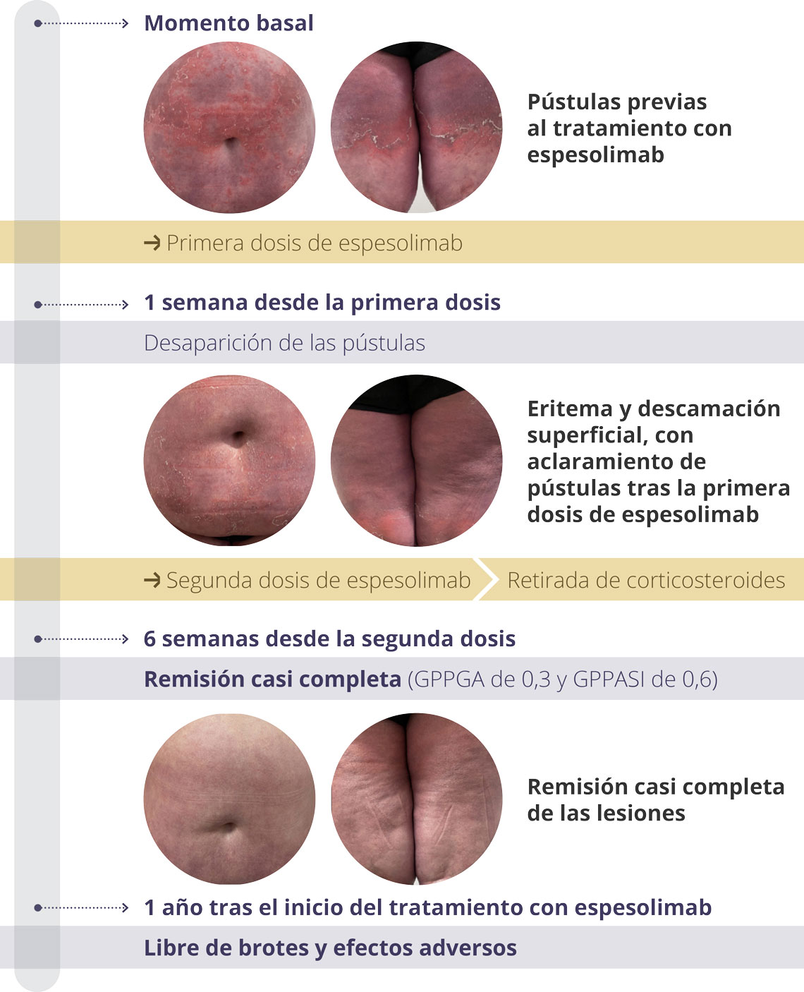 Indicación de espesolimab